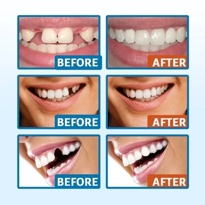 🦷Temporary Tooth Sculptor Repair Kit