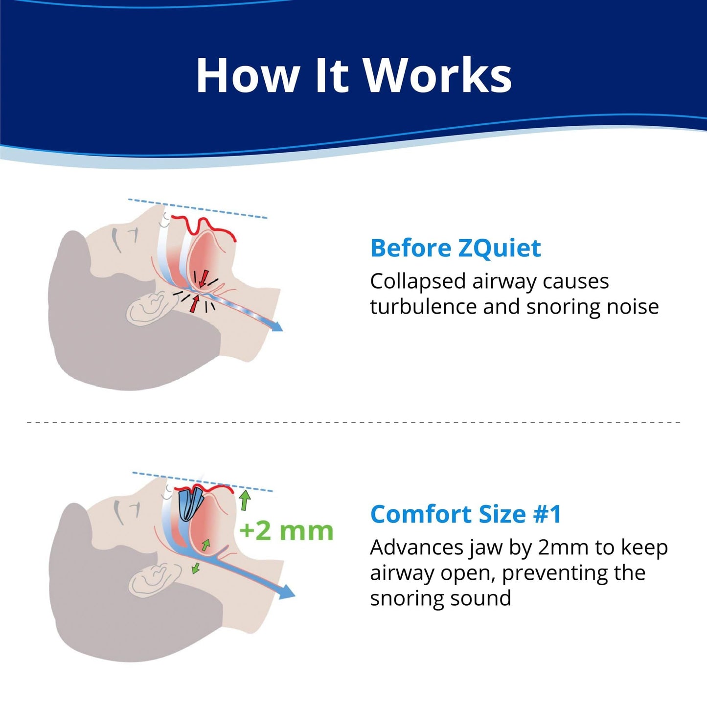 Anti-Snoring Mouthpiece-2 Pcs